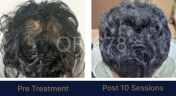 Blog 5 Hair Transplant