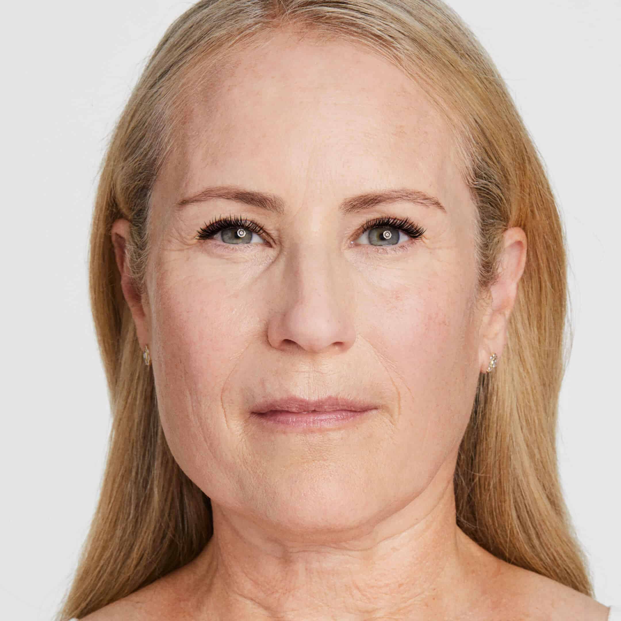 slider-debbie-before Ultherapy